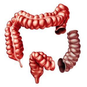 Colectomy
