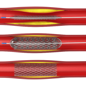 Interventional Cardiology