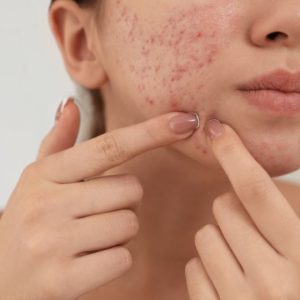 Acne Treatment