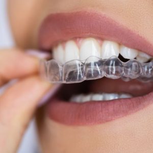 Aligners and Bracers