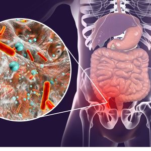 Appendectomy