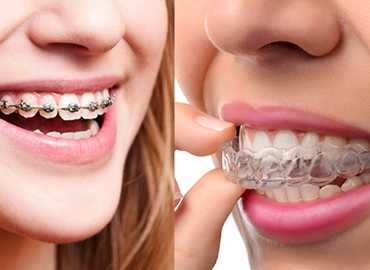 Orthodontic Treatments