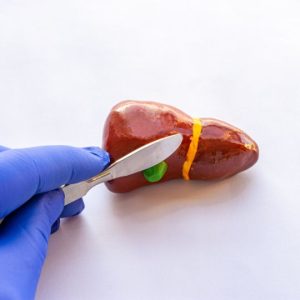 Cholecystectomy