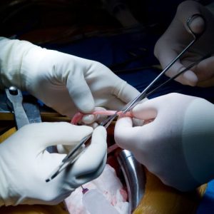 Coronary Artery Bypass Grafting