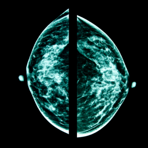 Mammography
