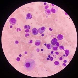 Multiple Myeloma