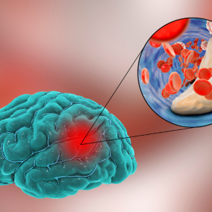 Neurological Disorders