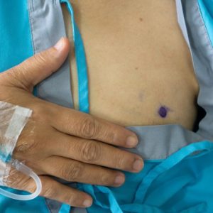 Mastectomy Surgery