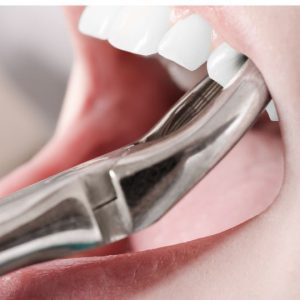 Wisdom Tooth Removal And Extraction