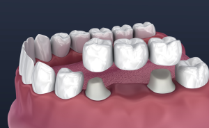 Dental Crowns and Bridges