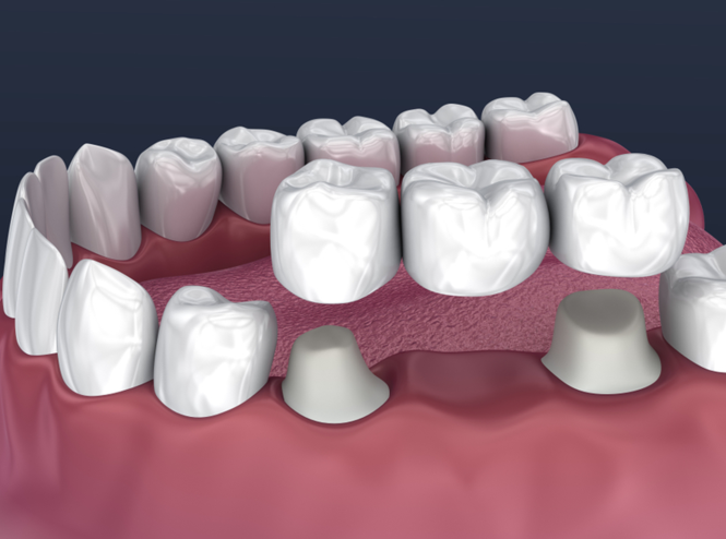 Dental Crowns and Bridges