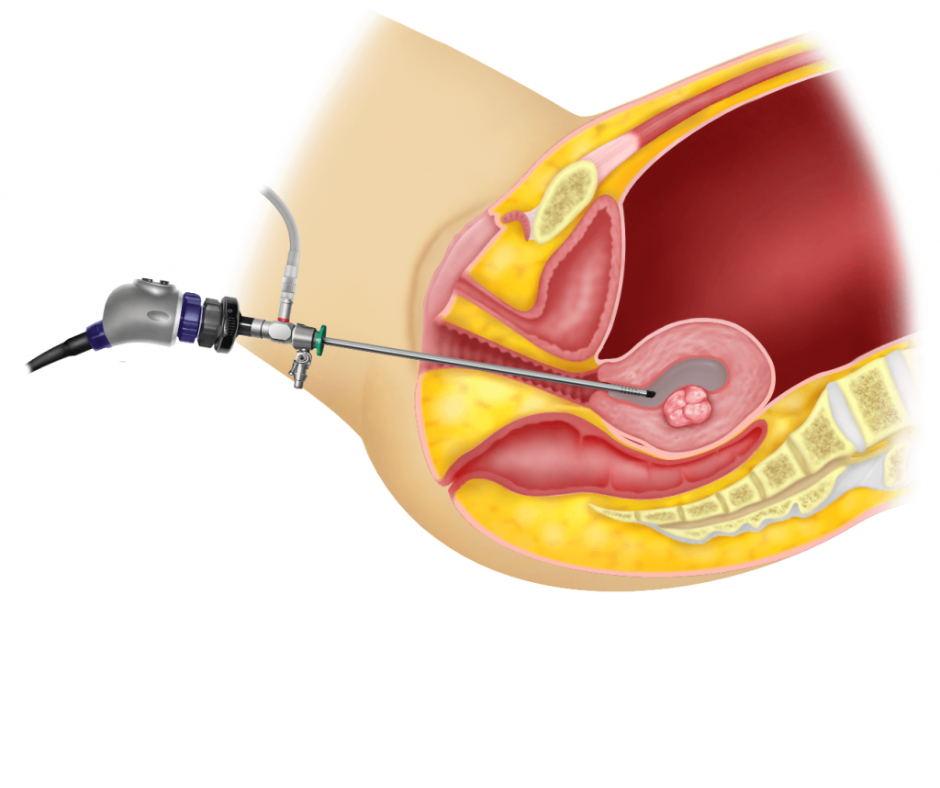 Hysteroscope