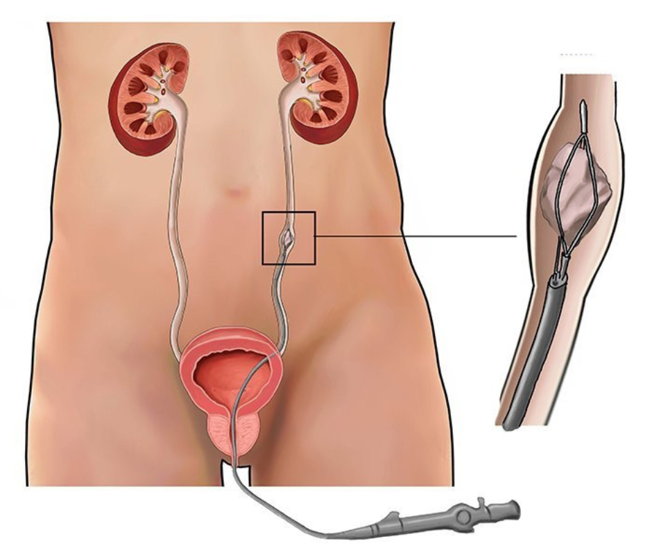Ureteroscopy (Stone Removal)